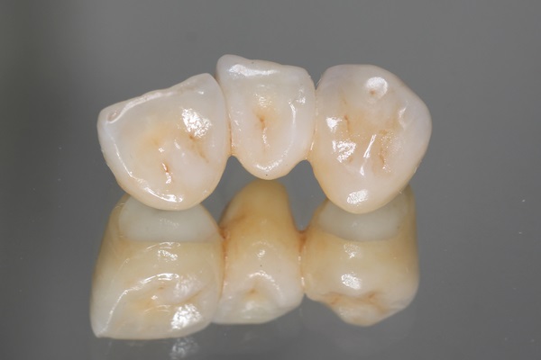 General Dentistry: What Is A Tooth Bridge?