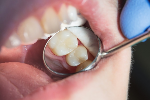 Dental Filling Procedure Steps