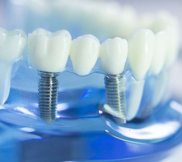 Cookeville Dental Implants